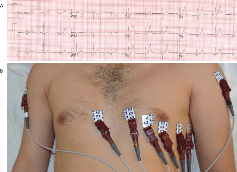 Common Ecg Lead Placement Errors Part Ii Precordial Misplacements