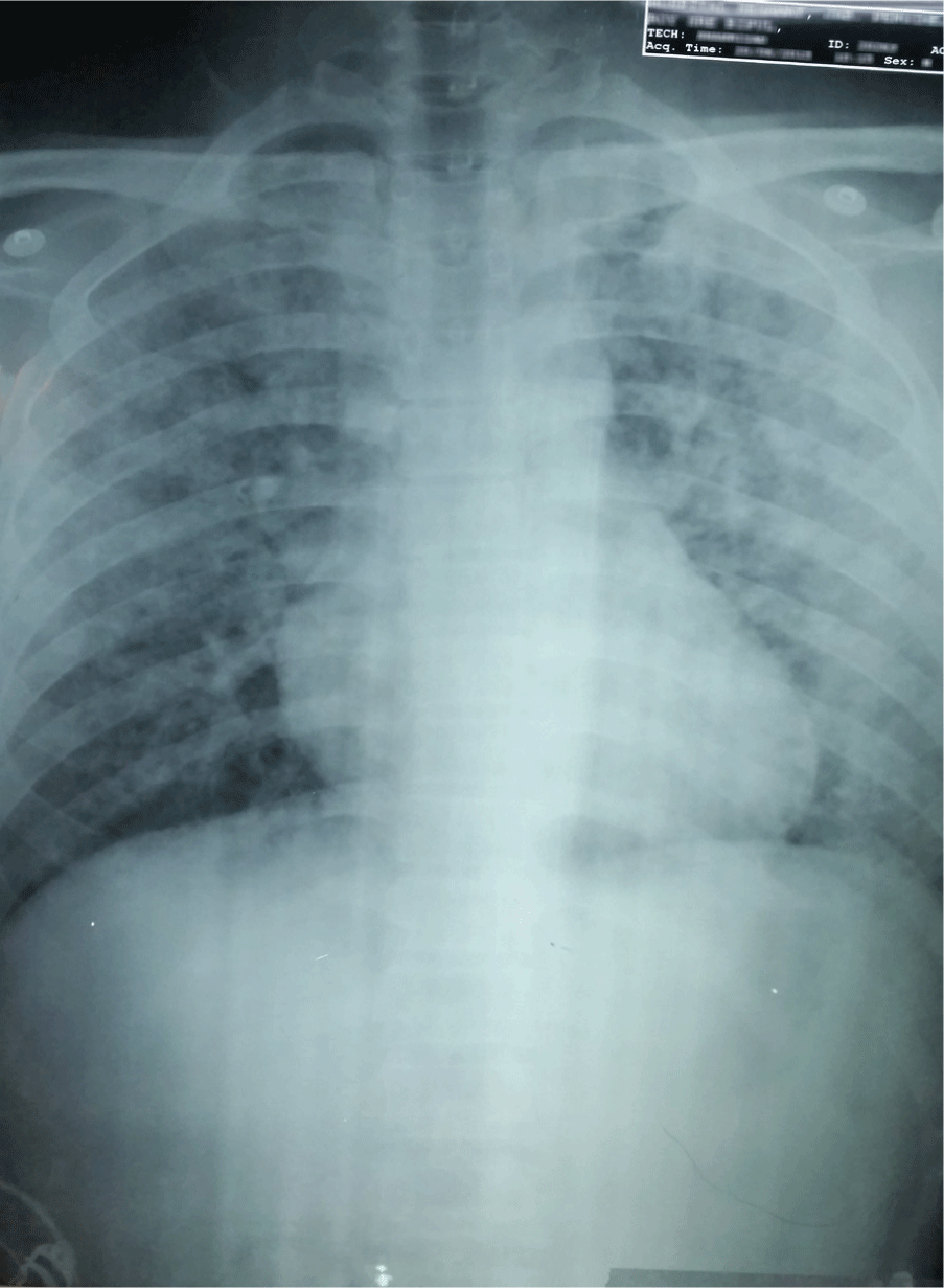 Methylprednisolone-Responsive Leptospiral Acute Pulmonary Syndrome: A ...