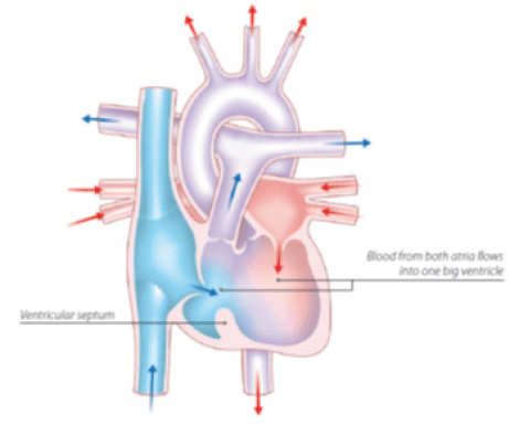 Double Inlet Left Ventricle with Eisenmenger Syndrome in an Adult – A ...