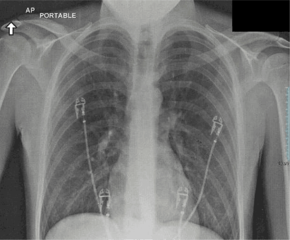 st-segment-elevation-and-normokalemia-in-acute-diabetic-ketoacidosis