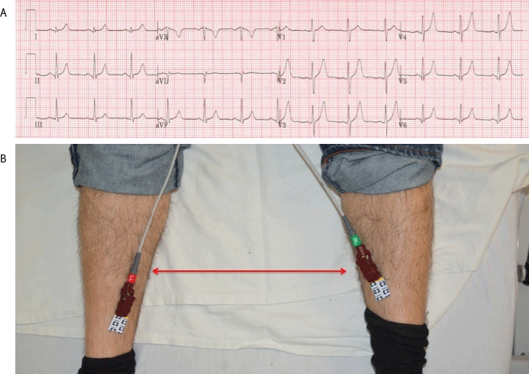 common-ecg-lead-placement-errors-part-i-limb-lead-reversals