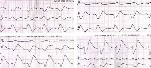 The image displays four segments of an electrocardiogram (ECG) titled "Initial 12-Lead ECG Indicative of Severe Hyperkalemia." Each segment shows a tracing of heart rhythm and electrical activity. The rhythm is regular, but the ECG demonstrates a sine-wave pattern, a sign often associated with severe hyperkalemia. This pattern includes extremely wide QRS complexes, an absence of a discernible ST-segment, and broadly based T-waves, which are characteristic changes in the heart's electrical pattern when potassium levels are critically high. The visual is a clinical representation commonly used by healthcare professionals to diagnose and assess the severity of hyperkalemia.