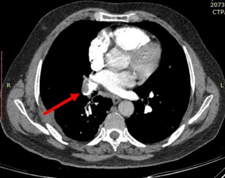 CT Pulmonary Angiogram Showing Thrombo-Embolism in he Right Pulmonary Trunk.