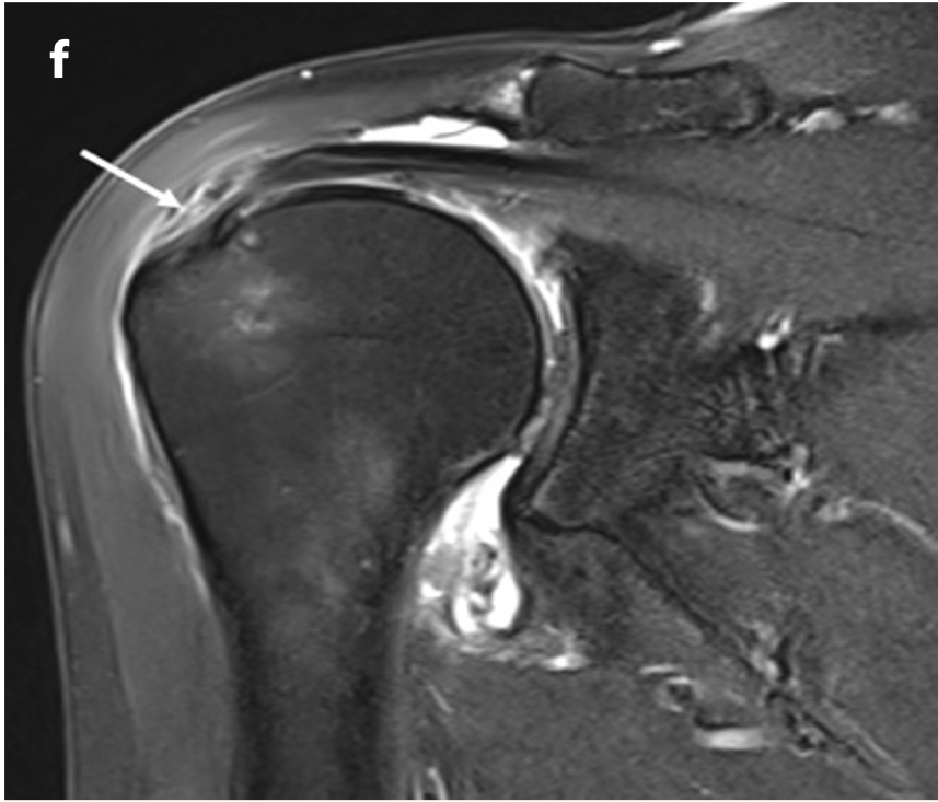 The MRI image labeled f shows a T2 fat-suppressed scan of the shoulder, specifically highlighting severe supraspinatus tendinosis. The white arrow points to a high-grade partial-thickness tear on the bursal surface of the tendon. This tear is consistent with chronic rotator cuff injury, where the tendon has undergone degenerative changes, leading to tearing and inflammation​.