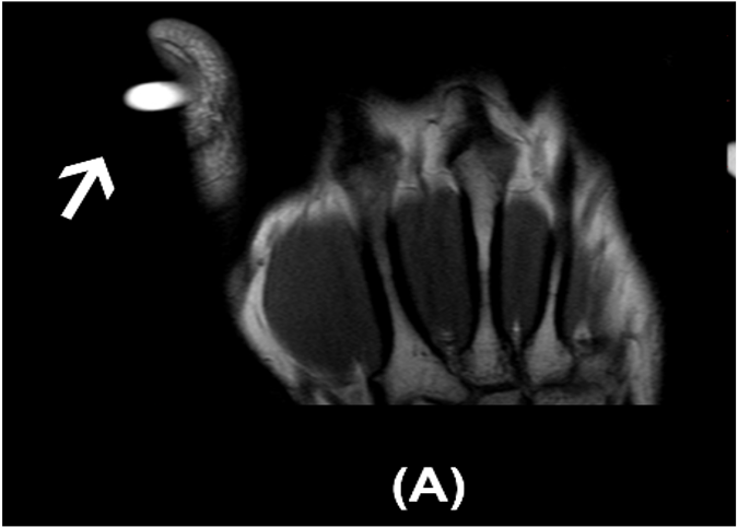 The image labeled (A) is a T2-weighted MRI scan of the patient's left hand, focusing on the thumb, as described in the article. It reveals a well-demarcated, hyperdense lesion (indicated by the arrow) located in the subungual region of the distal phalanx. This lesion corresponds to a glomus tumor, which was causing the patient’s symptoms of throbbing pain, particularly exacerbated by cold. The scan helped confirm the diagnosis, leading to a successful surgical excision through a transungual approach​.