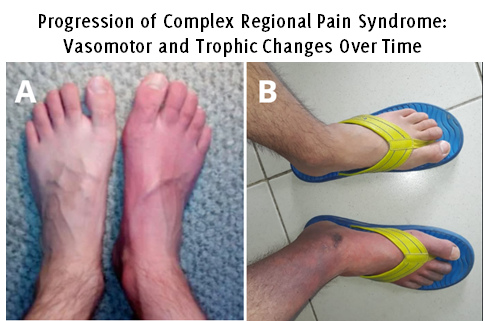 This image shows two panels labeled A and B, illustrating a comparison of feet with discoloration. Panel A shows a pair of bare feet where the right foot exhibits significant redness or erythema compared to the left foot, which appears normal. Panel B shows a person’s feet wearing flip-flops, where the right foot appears swollen with a dark, purplish discoloration compared to the left foot, which looks unaffected. The images highlight a visible difference in color and swelling between the two feet, possibly indicating a medical condition such as inflammation, vascular compromise, or injury.