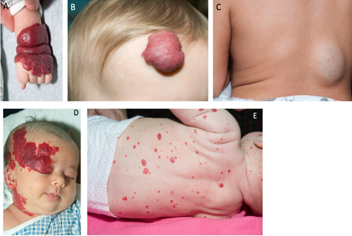 The image titled "Infantile Hemangiomas" showcases different types of hemangiomas in infants: a segmental hemangioma on the arm (A), a superficial hemangioma on the forehead (B), a deep hemangioma on the back (C), a facial hemangioma linked to PHACES syndrome (D), and multiple hemangiomas (E) indicating increased risk of internal involvement. These examples highlight the varied presentations and potential complications of infantile hemangiomas​.